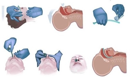 Nasopharyngeal Airway Latex Free - Buy Nasopharyngeal Airway latex free ...